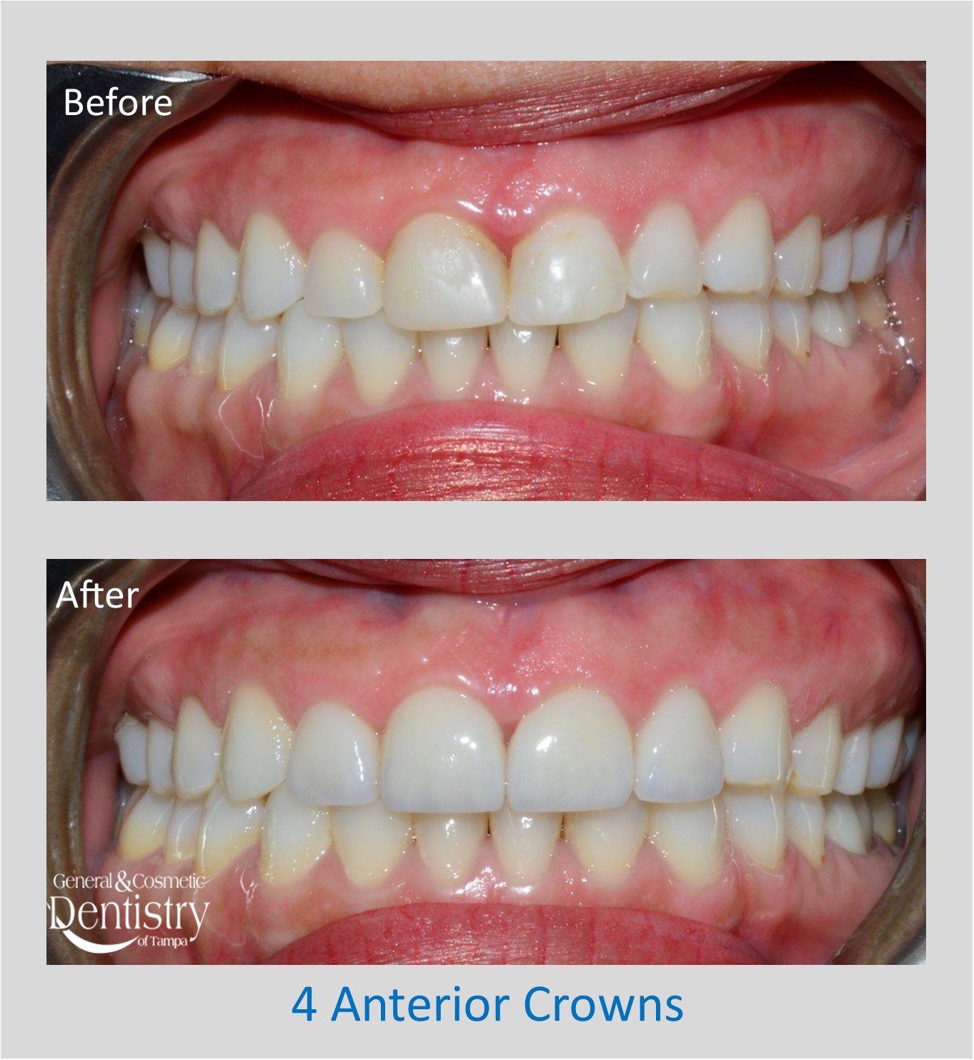 Bonding of Broken Teeth
