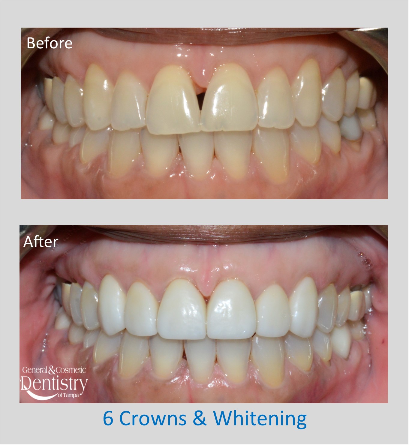 Bonding of Broken Teeth