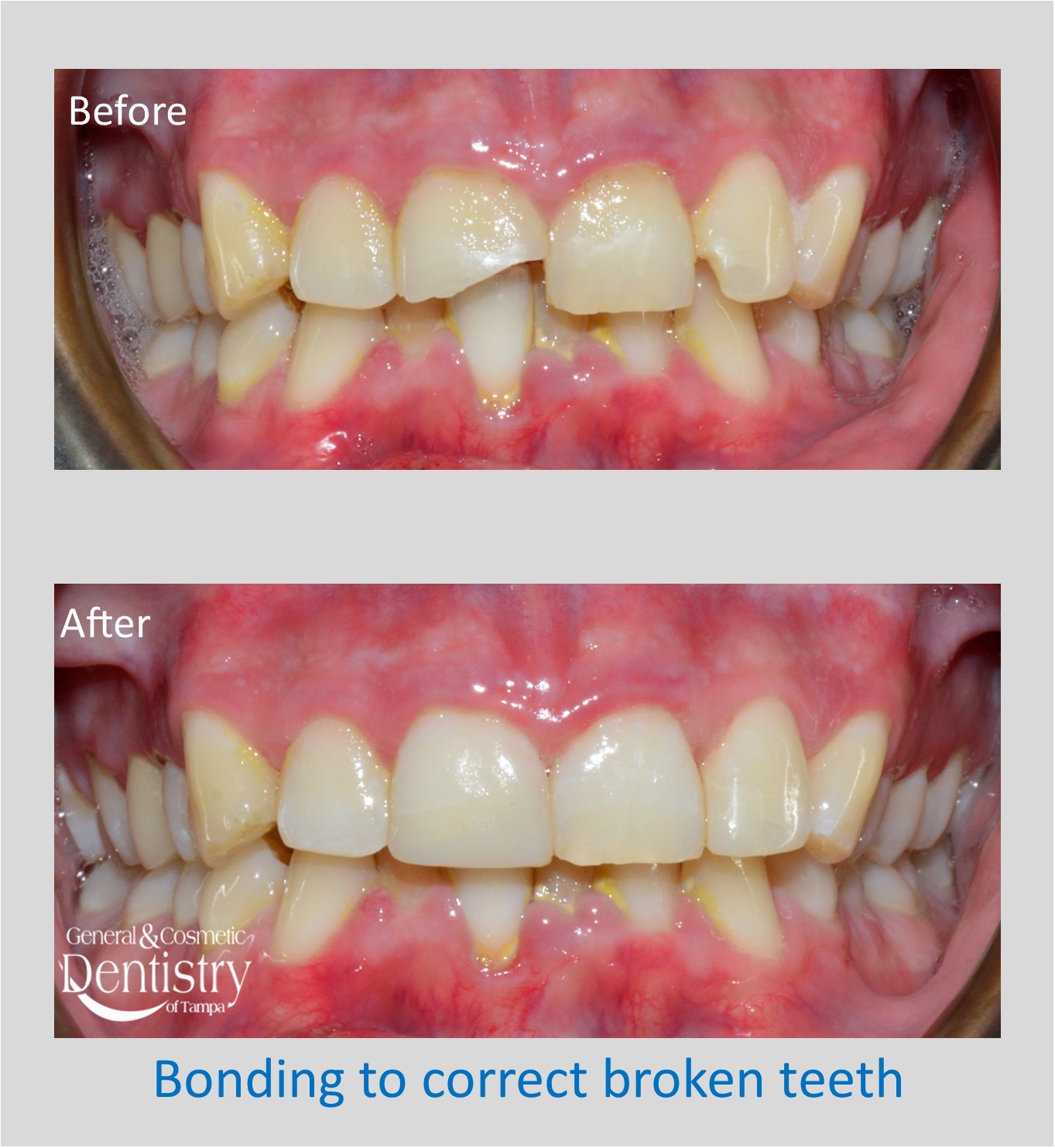 Bonding of Broken Teeth