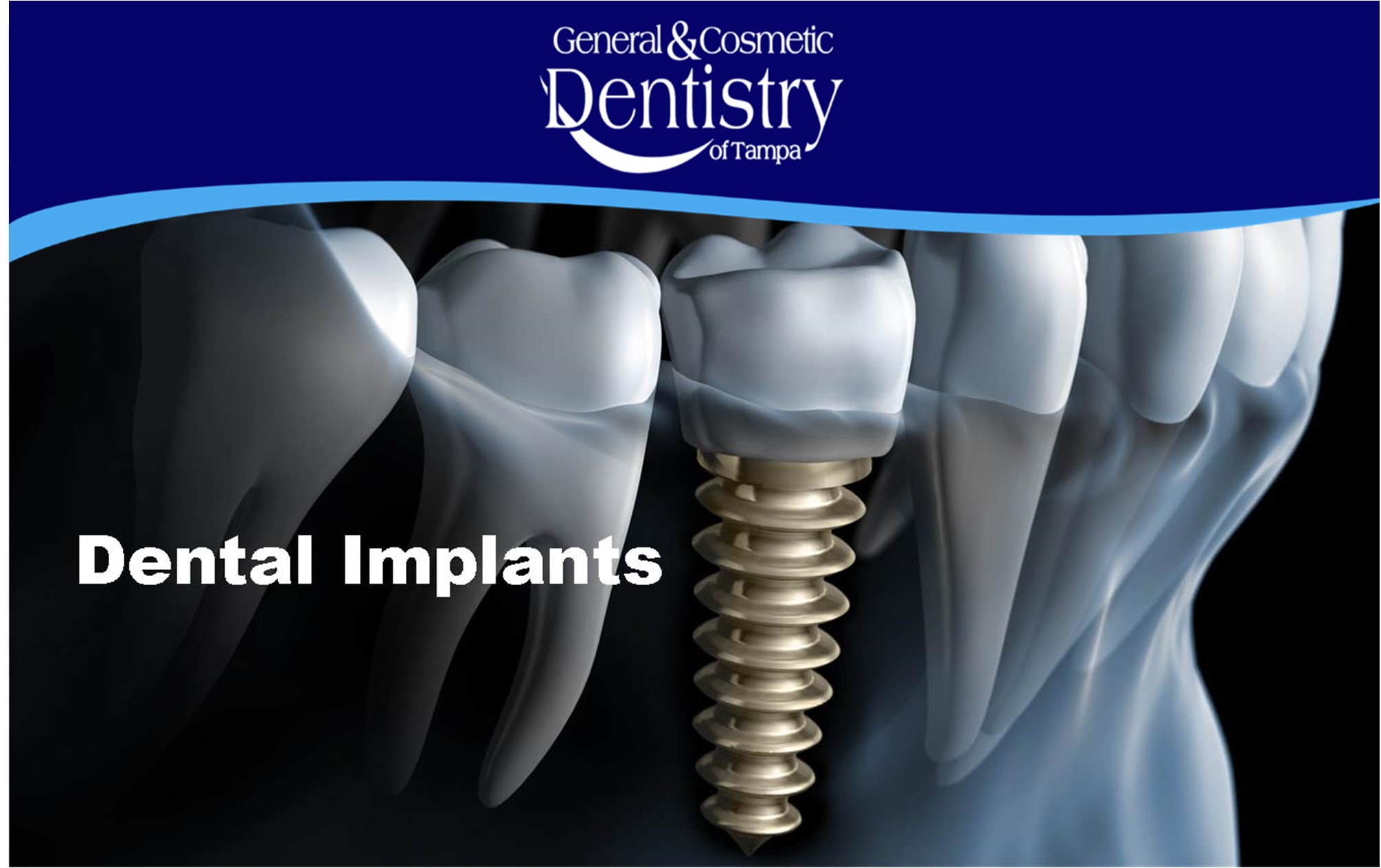 General and Cosmetic Dentistry of Tampa - Randall Diez and Michael Diez