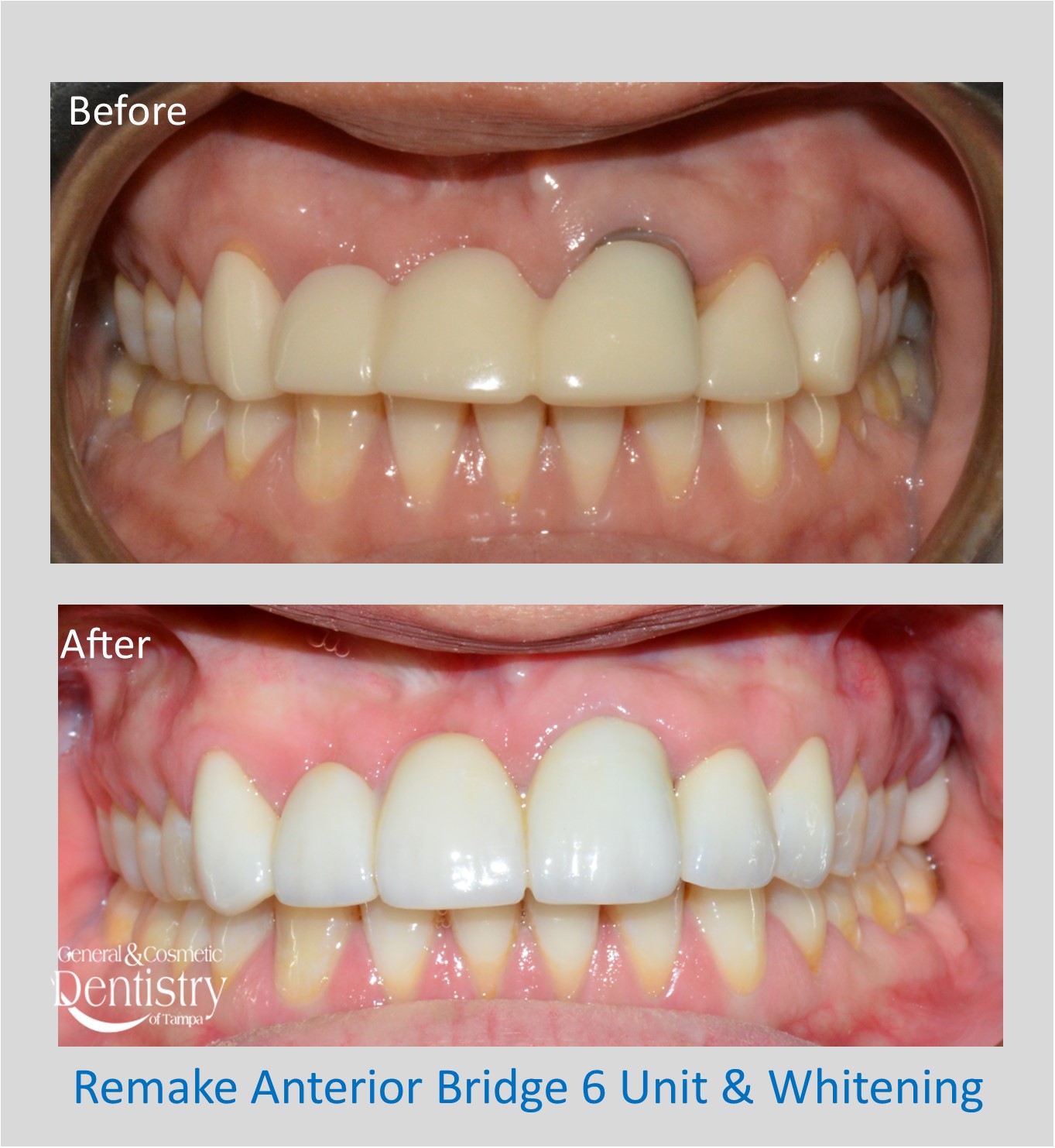 Bonding of Broken Teeth