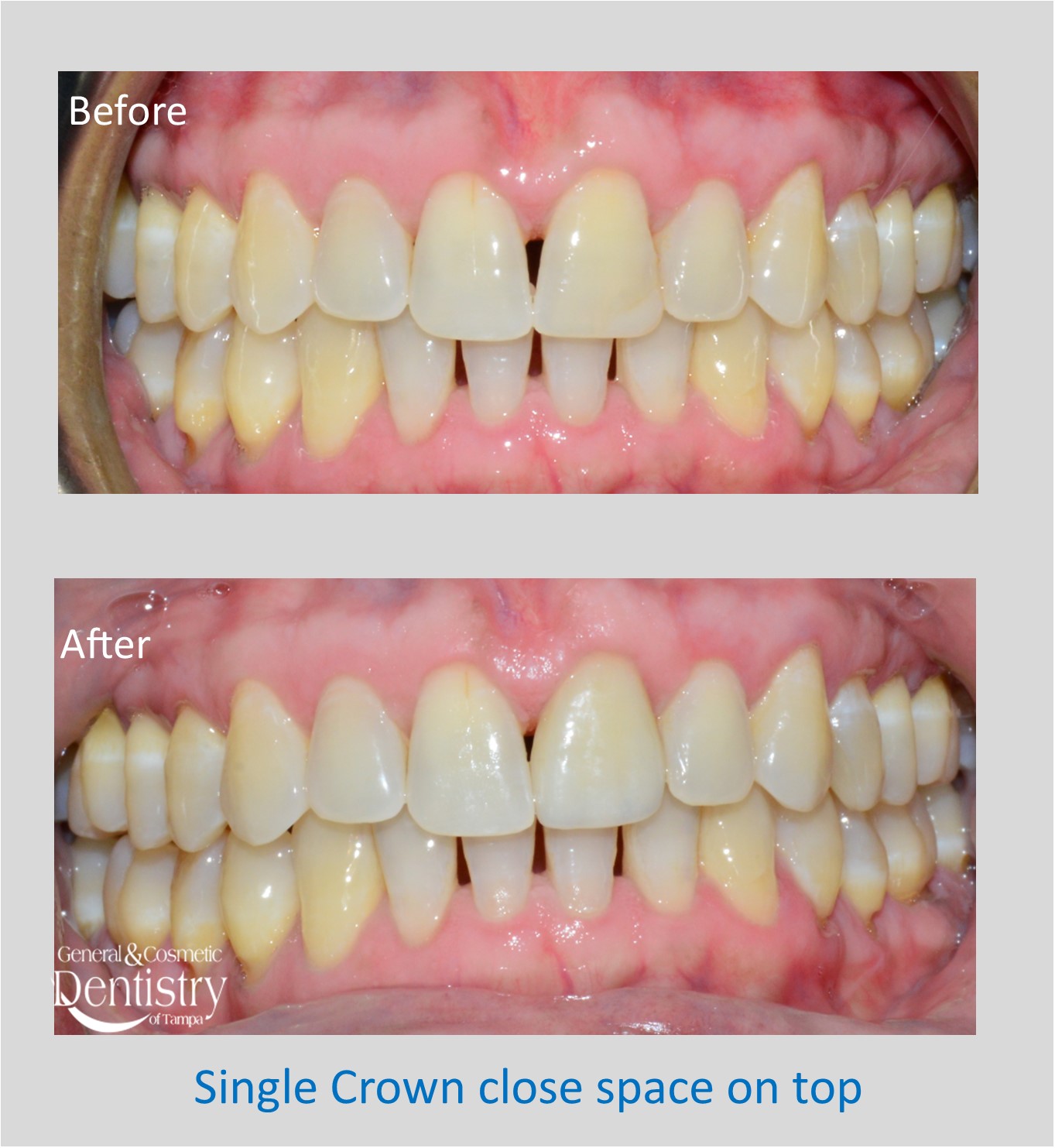 Bonding of Broken Teeth